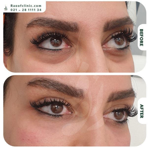 1 فیلر زیر چشم