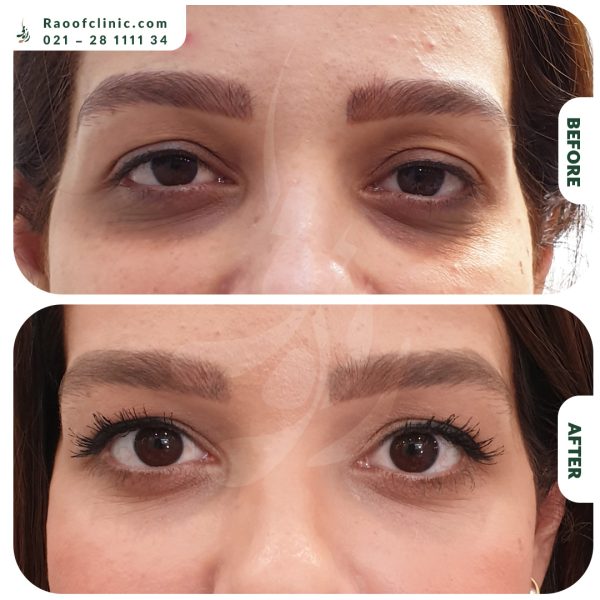 2 فیلر زیر چشم