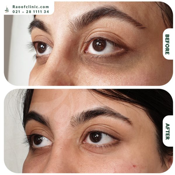 3 فیلر زیر چشم