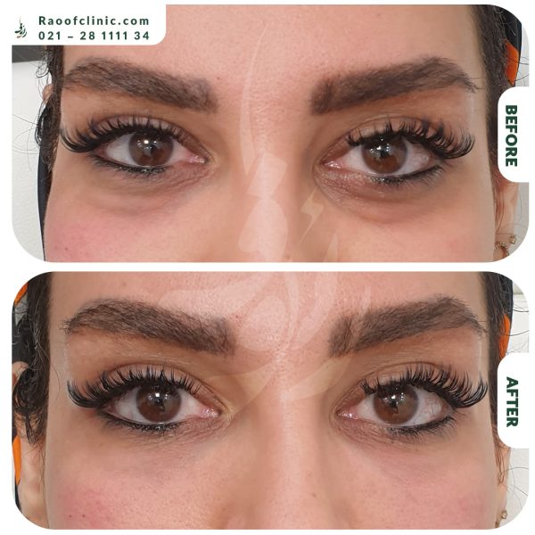 4 فیلر زیر چشم