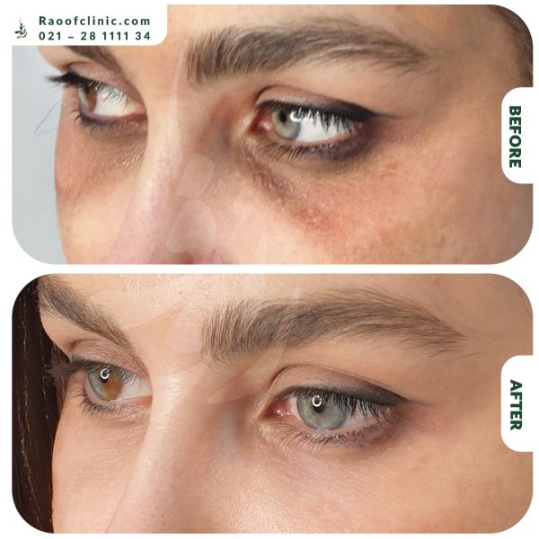 5 فیلر زیر چشم