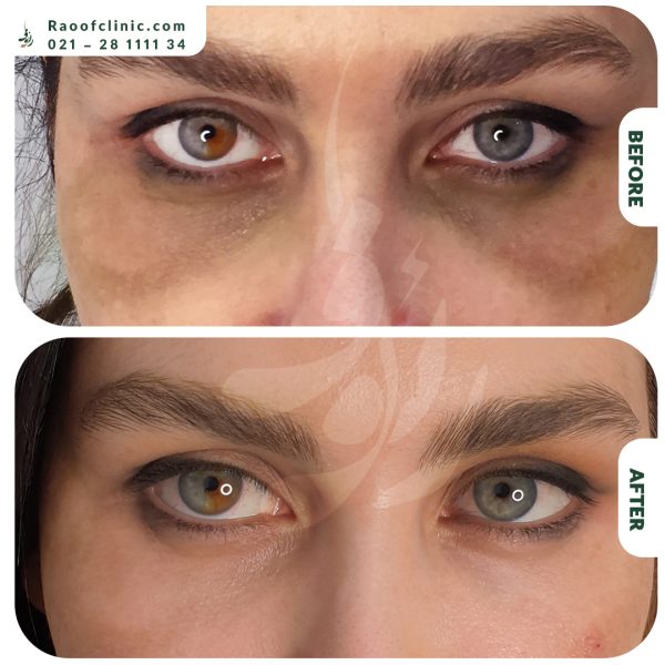 6 فیلر زیر چشم