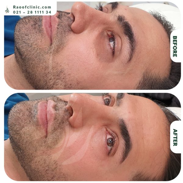 7 فیلر زیر چشم