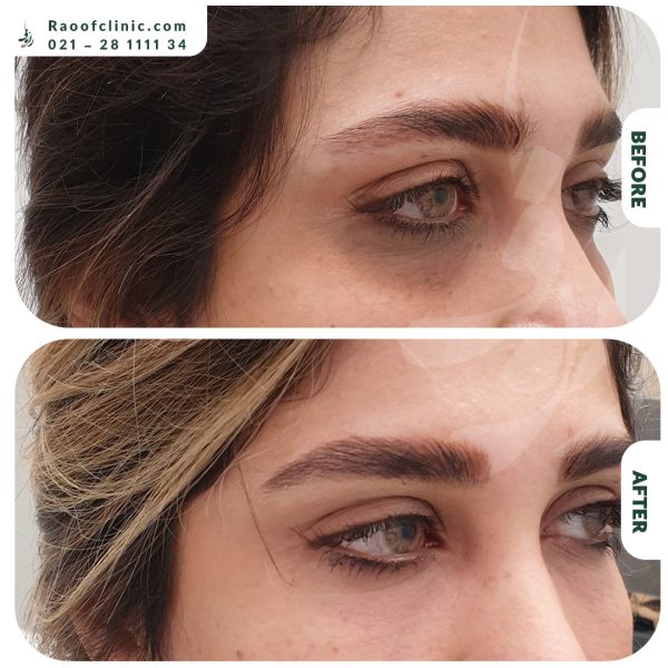 8 فیلر زیر چشم