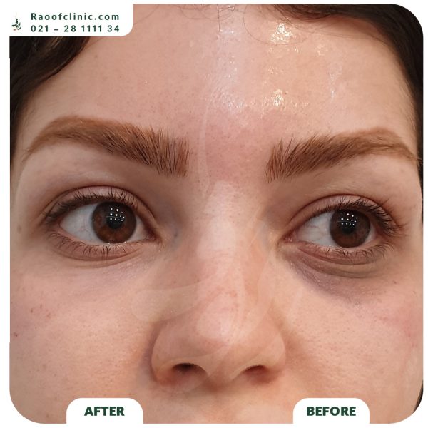 9 فیلر زیر چشم